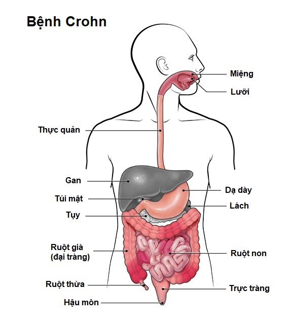Crohn (Bệnh Crohn)