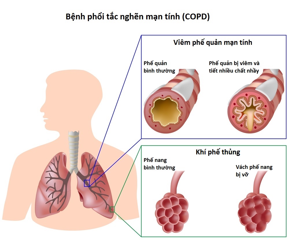 Bệnh phổi tắc nghẽn mãn tính (COPD)