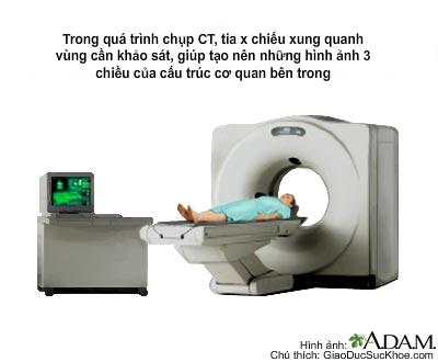 CT scan (CAT scan)