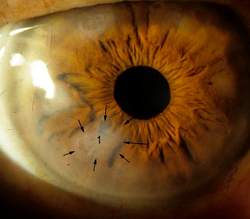 Một số bệnh về mắt ở người cao tuổi