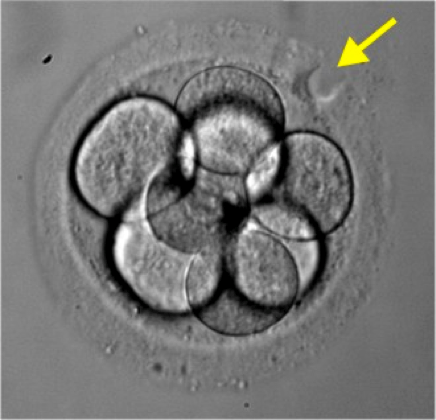 Hỗ trợ phôi thoát màng trong IVF (thụ tinh trong ống nghiệm)