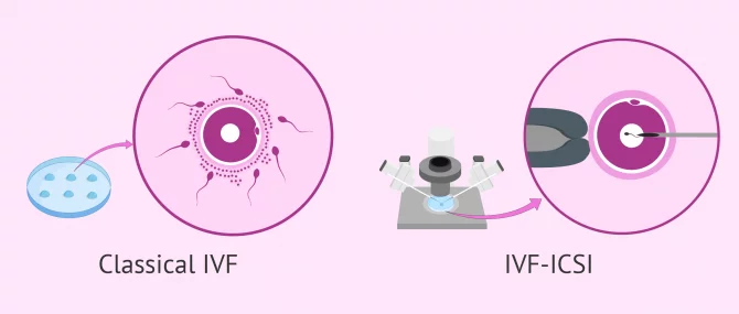 IVF cổ điển & IVF-ICSI