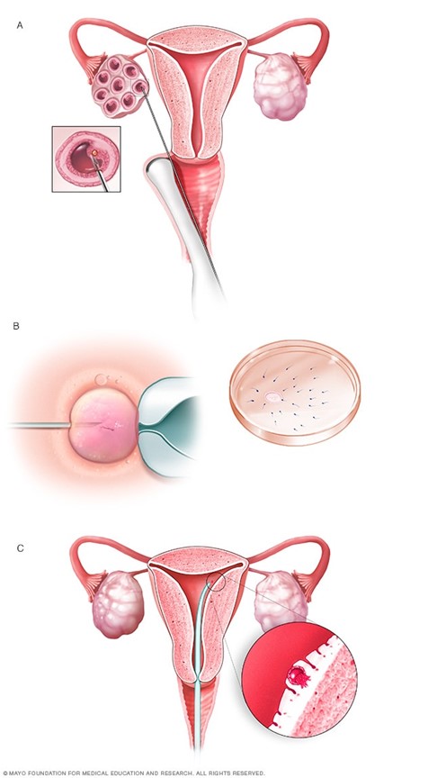 IVF (Thụ tinh trong ống nghiệm)