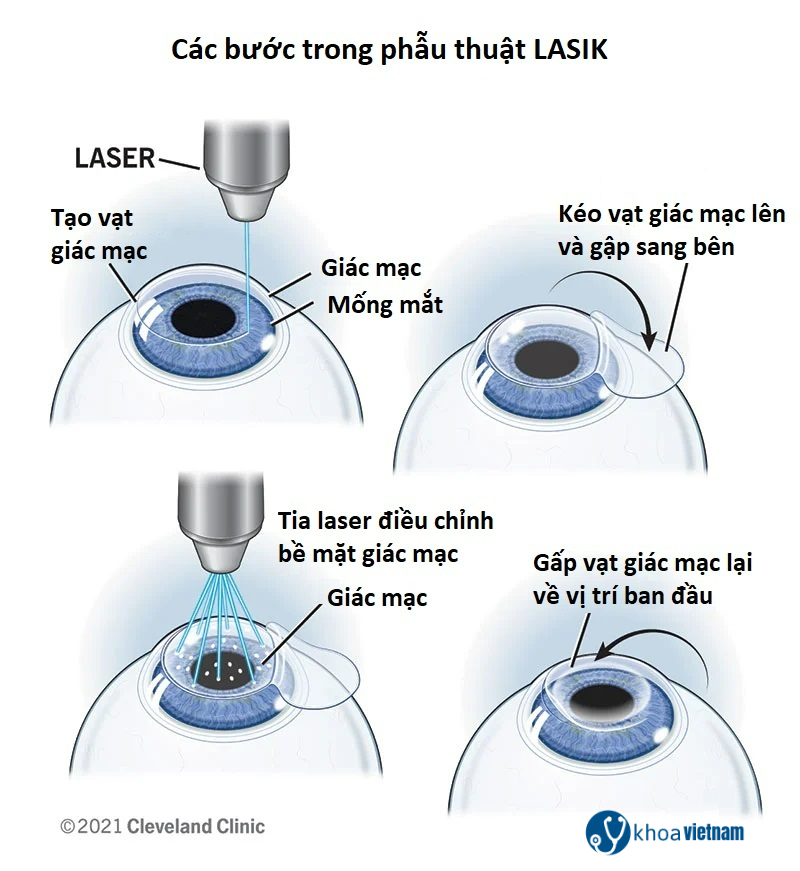 Phẫu thuật mắt LASIK