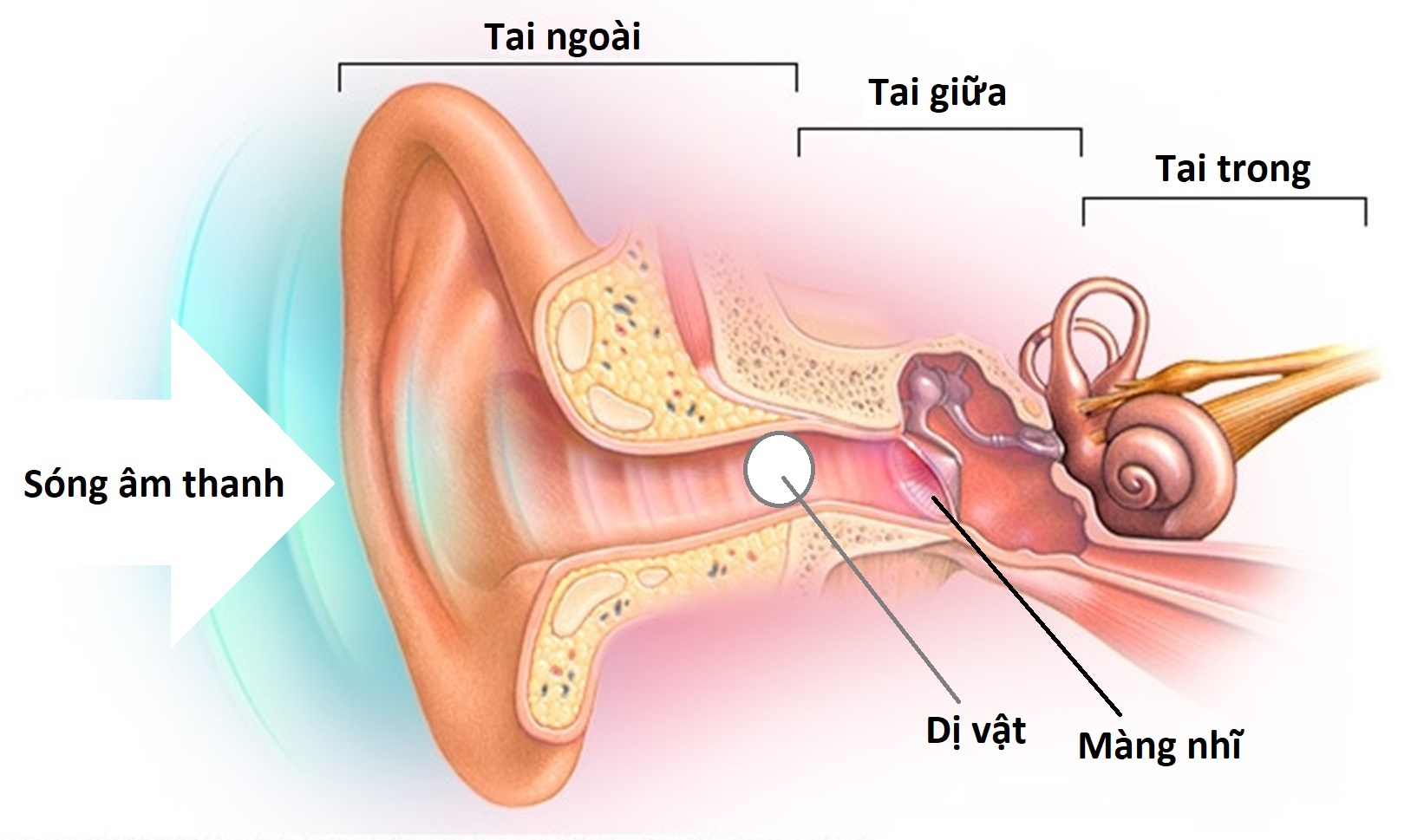 Lấy dị vật trong tai