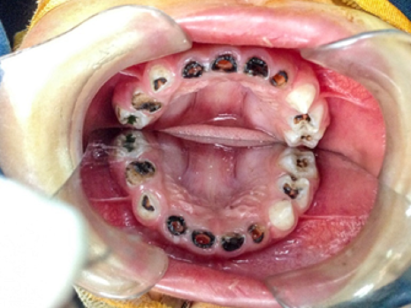 Sâu răng và dự phòng sâu răng ở trẻ em