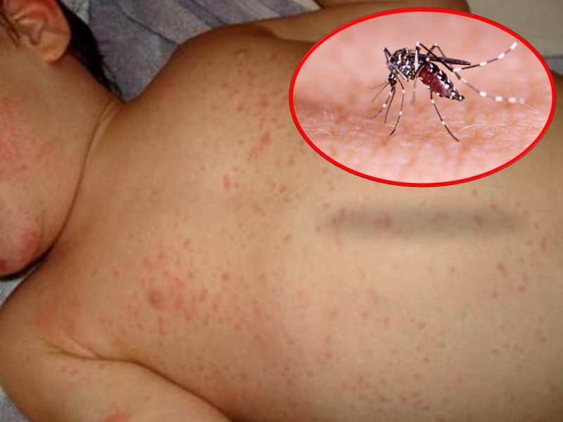 Sốt xuất huyết dengue: Các quan niệm chưa đúng về bệnh