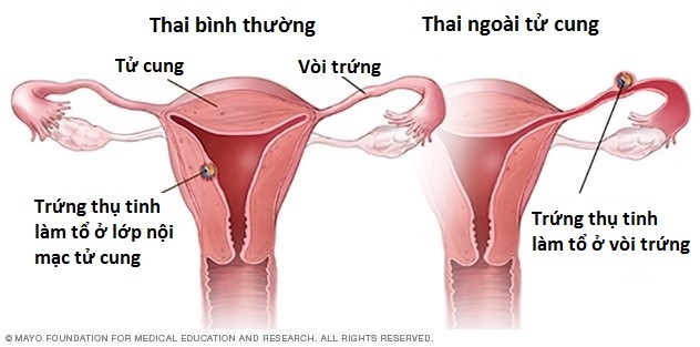 Thai ngoài tử cung 
