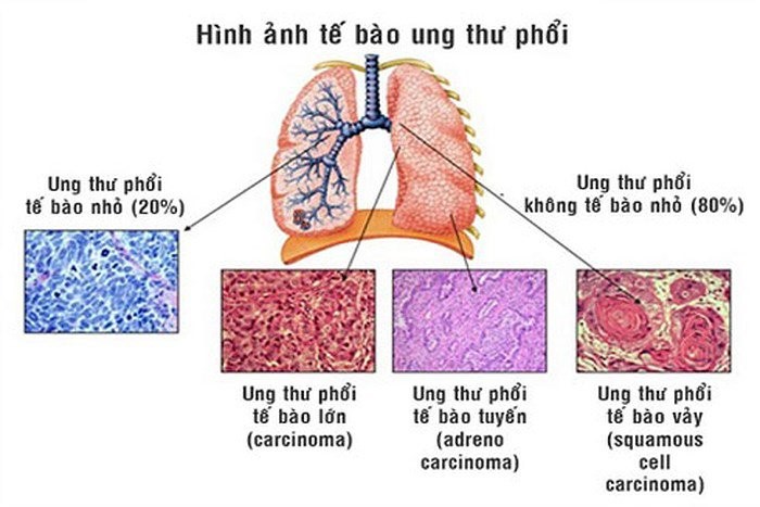 Các loại ung thư phổi