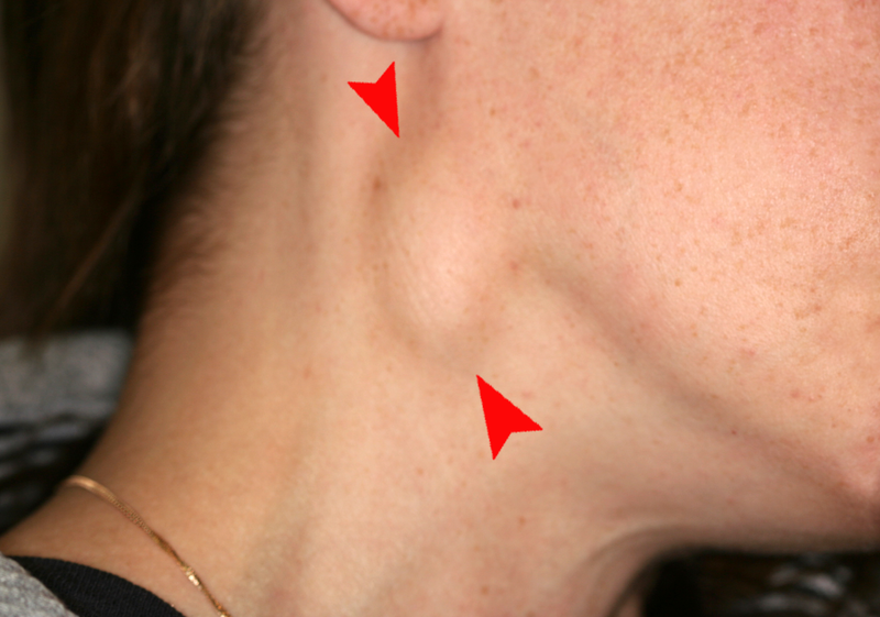 Ung thư tai mũi họng: Một số dấu hiệu cảnh báo
