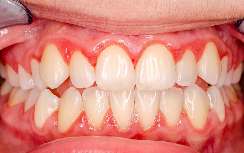 Viêm nướu răng (viêm lợi)